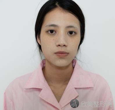 山西医科大学医院整形美容科自体脂肪面部填充手术怎么样？内附真实案例-价