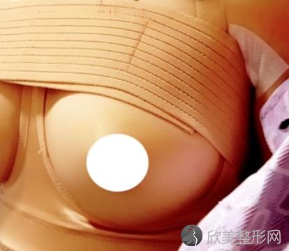 北京八大处穆大力隆胸手术做的怎么样？内附真实案例不要错过_较新价格表查