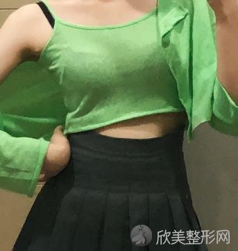 苏州市立医院整形美容科腰腹吸脂整形技术怎么样？真实案例分享看看吧-价格
