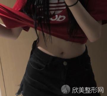 苏州市立医院整形美容科腰腹吸脂整形技术怎么样？真实案例分享看看吧-价格