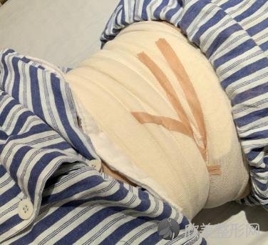苏州市立医院整形美容科腰腹吸脂整形技术怎么样？真实案例分享看看吧-价格