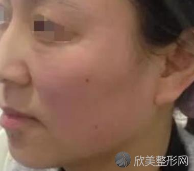 八大处唐勇脂肪填充做得好吗？内附案例前后对⽐照2021年价格表