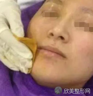 八大处唐勇脂肪填充做得好吗？内附案例前后对⽐照2021年价格表