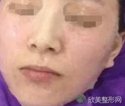 八大处唐勇脂肪填充做得好吗？内附案例前后对⽐照2021年价格表