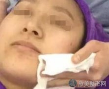 八大处唐勇脂肪填充做得好吗？内附案例前后对⽐照2021年价格表