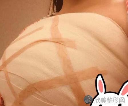 八大处刘春军隆胸手术做的怎么样？内附真实案例价格表⼀览
