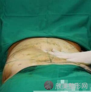 武汉同济医院整形科吸脂瘦身怎么样？内附案例一及价格表
