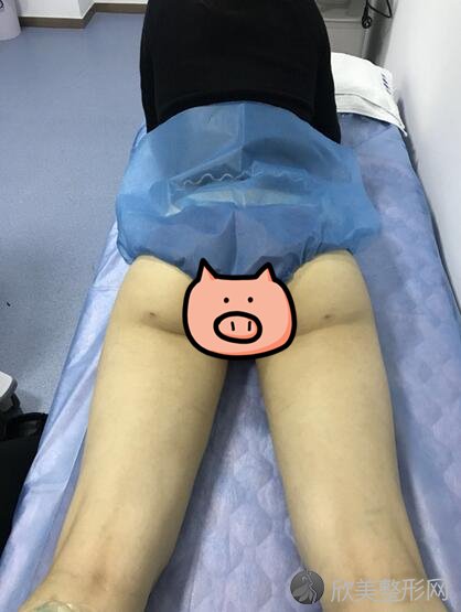 郑州至美整形医院刘永生大腿吸脂怎么样？附价案例分享以及价格表