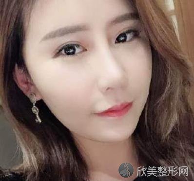 北京艺美王东医生脂肪填充好不好？附真实效果图-价格表