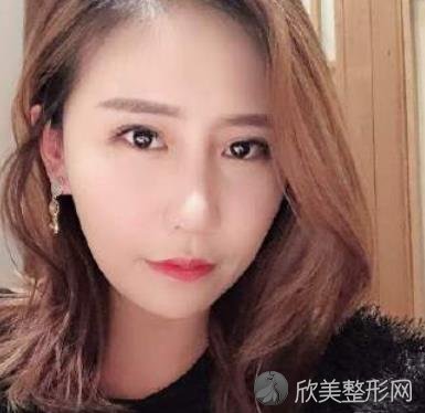 北京艺美王东医生脂肪填充好不好？附真实效果图-价格表