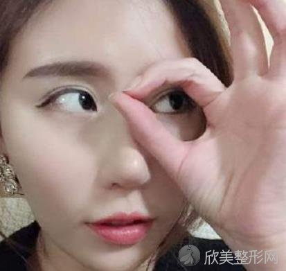 北京艺美王东医生脂肪填充好不好？附真实效果图-价格表