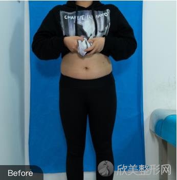 重庆光博士做大腿抽脂如何？附案例及腰腹/大腿/全身吸脂的价格表参考