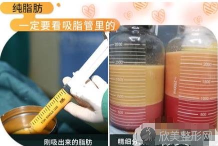 重庆光博士做大腿抽脂如何？附案例及腰腹/大腿/全身吸脂的价格表参考