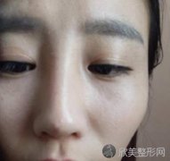 北京艺美王东医生脂肪填充好不好？附真实效果图_价格表
