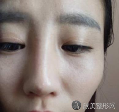 北京艺美王东医生脂肪填充好不好？附真实效果图-价格表