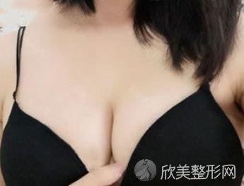北京中日友好曾高做胸部整形好不好？附隆胸真人案例及效果图一览-价格表查