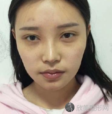 在扬州苏北人民医院整形科做了面部填充，效果分享【亲测】