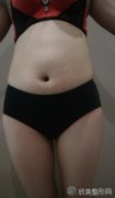 郑州悦美整形闫海廷大腿吸脂案例，效果倍儿好!