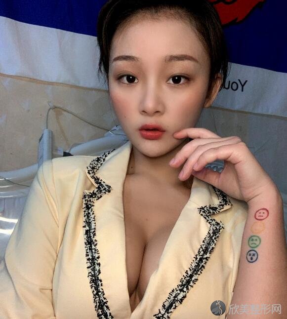 终于做完隆胸了，程晓琳是我的主刀医生我很感谢她！