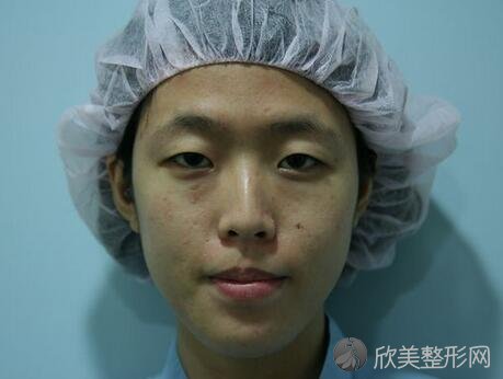 广州艾尚美医疗美容院价格表，附埋线双眼皮案例