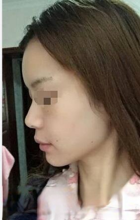 德州天宏整形医院宋海涛医生做脂肪填充靠谱吗？附面部填充案例