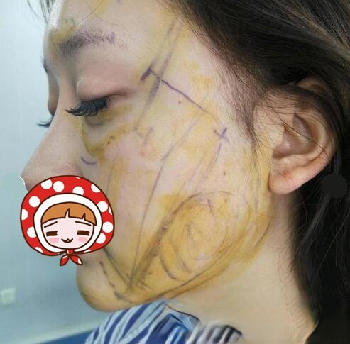 华西王杭医生脂肪填充案例图