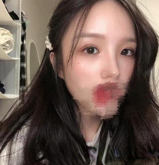 华西王杭医生技术好么？附植发填充和做双眼皮真实案例