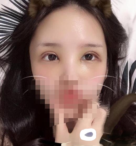 华西王杭医生技术好么？附植发填充和做双眼皮真实案例