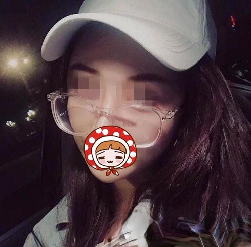 华西王杭医生脂肪填充案例图