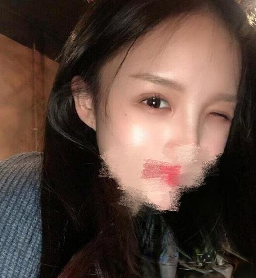 华西王杭医生技术好么？附植发填充和做双眼皮真实案例