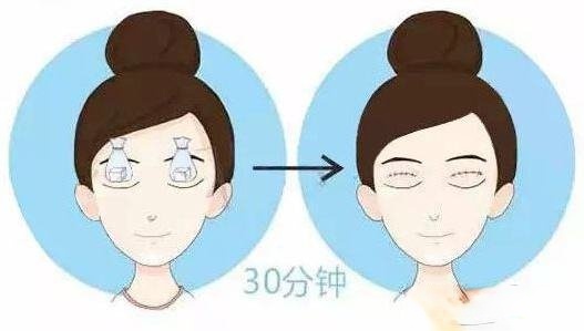 华西医院王杭医生科普双眼皮手术