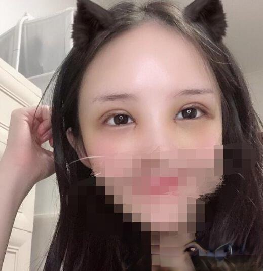 华西王杭医生技术好么？附植发填充和做双眼皮真实案例