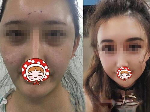 华西王杭医生脂肪填充案例图