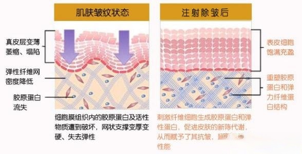 宁波徐建国医生科普面部除皱