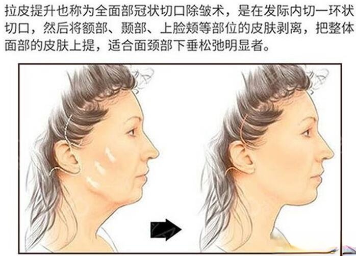 宁波徐建国医生科普面部除皱