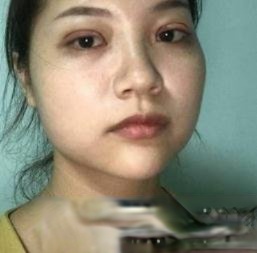 蚌埠二院高嵩做双眼皮怎么样？真人案例效果图片分享