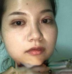 蚌埠二院高嵩做双眼皮怎么样？真人案例效果图片分享