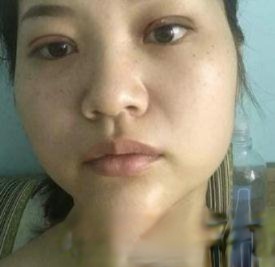 蚌埠二院高嵩做双眼皮怎么样？真人案例效果图片分享