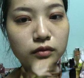 蚌埠二院高嵩做双眼皮怎么样？真人案例效果图片分享