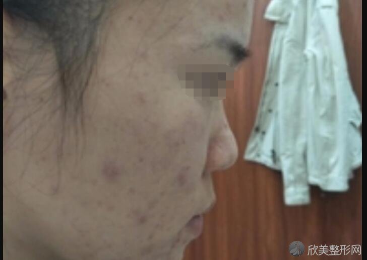 上海明桥整形医院口碑评价怎么样？治疗痤疮靠谱吗？