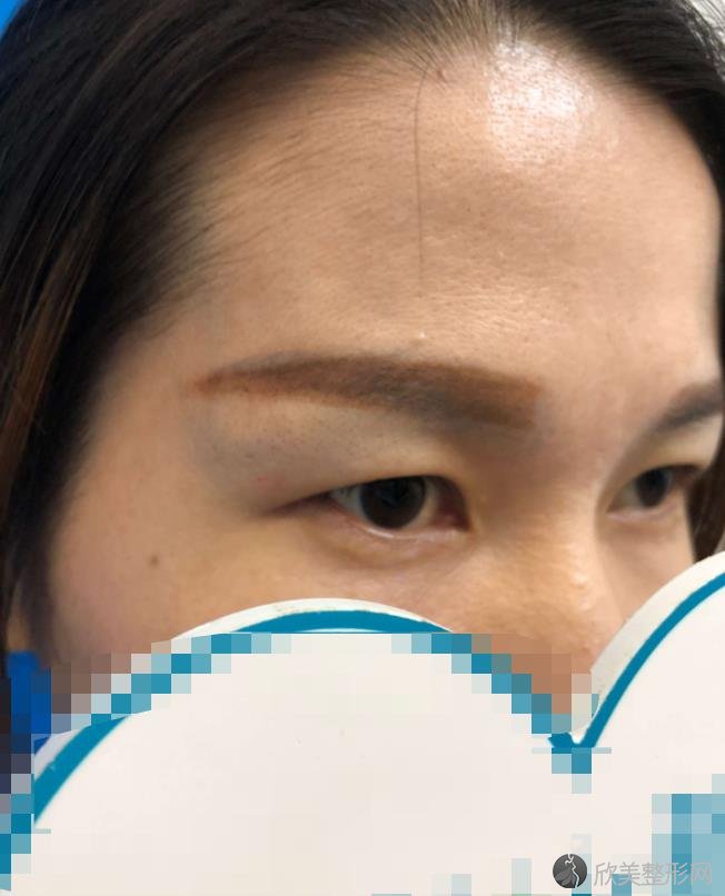 做眼综合之前