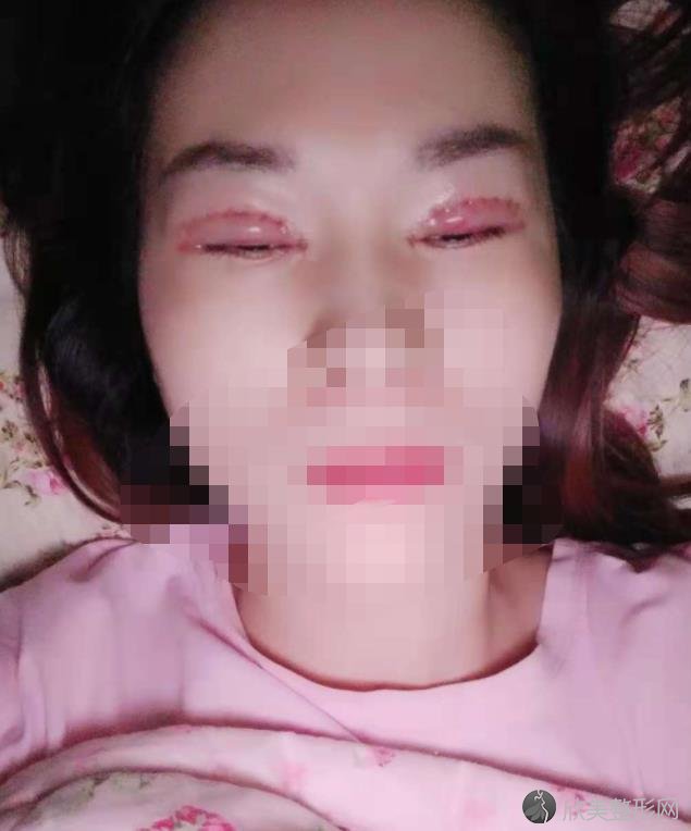 做眼综合之后