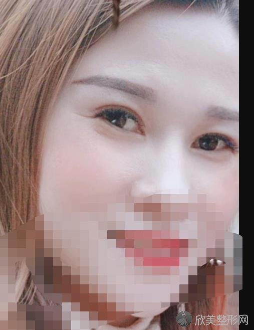 做眼综合之后