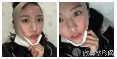 面部吸脂