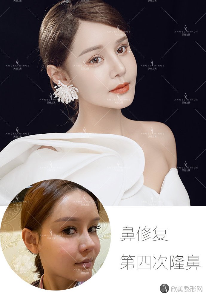 吴开泉鼻综合案例