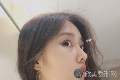 成都黄开亮鼻子做得好吗？成都黄开亮简介案例预约