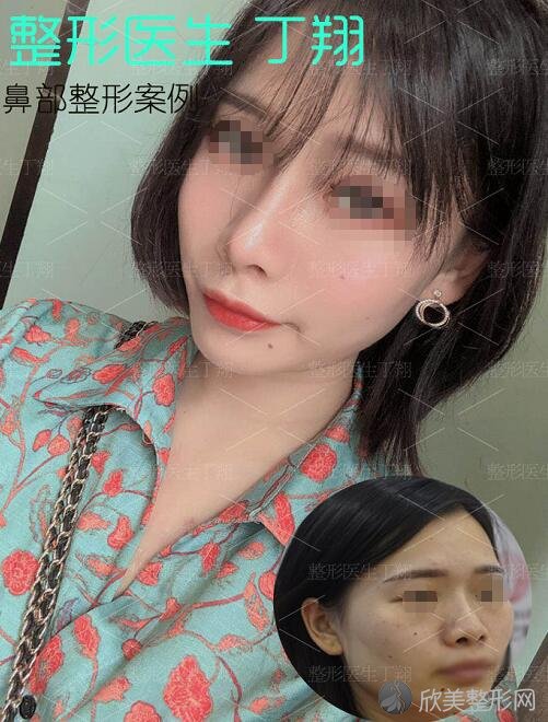 长沙哪个医生做鼻综合最好 长沙鼻综合医生预约排名附价格表 欣美整形网 长沙哪个医生做鼻综合最好 长沙鼻综合医生预约排名附价格表 欣美整形网