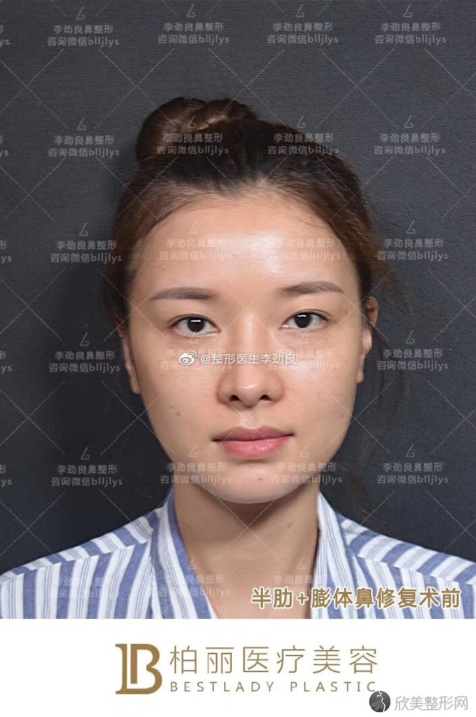 北京隆鼻修复*好的整形医生：巫文云和李劲良鼻修复哪个好？