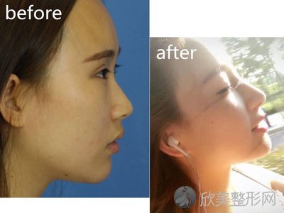 中国*好的隆鼻鼻修复专家：成铤（案例预约效果价格）在哪个医院坐诊？
