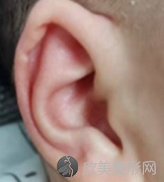 成都民生耳鼻喉专科医院耳再造怎么样？附案例分析及价格表